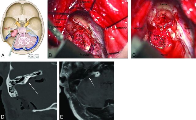 Intraoperative photograph showing retrosigmoid approach to the cerebellopontine angle for vestibular schwannoma removal