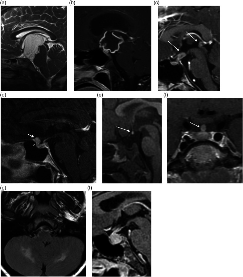 MRI comparison of different sellar and suprasellar lesions including pituitary adenoma, craniopharyngioma, and Rathke cleft cyst