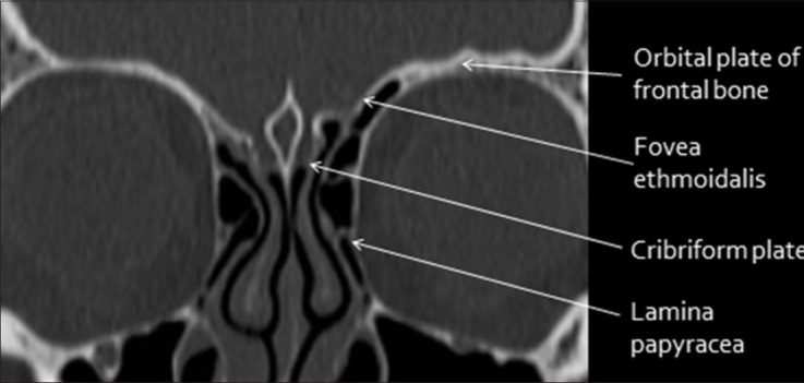 Coronal CT bone window of the anterior skull base showing the cribriform plate, orbital roofs, and crista galli