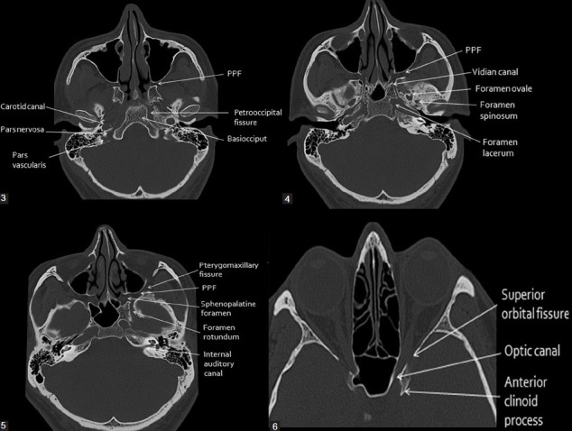 Axial CT bone window images of the skull base showing major foramina and apertures from inferior to superior