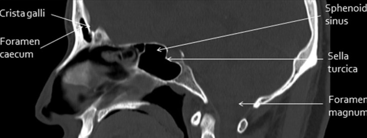 Sagittal CT bone window of the skull base showing the anterior, middle, and posterior cranial fossae