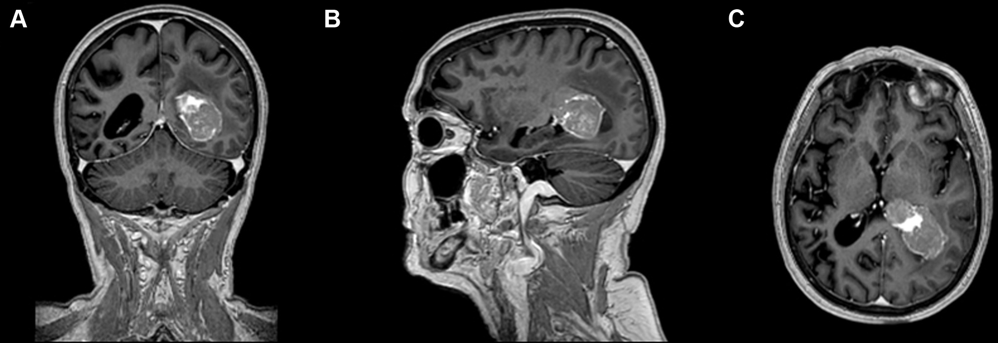 MRI of the thoracic spine showing metastatic spinal cord compression with vertebral body involvement and epidural tumor extension
