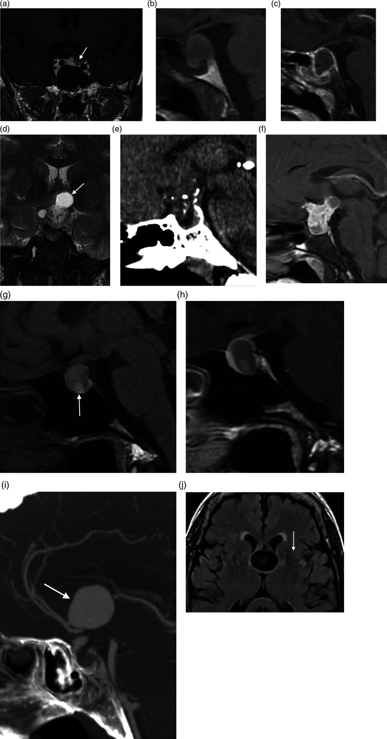 MRI images demonstrating sellar and suprasellar anatomy including the pituitary gland and ventricular landmarks