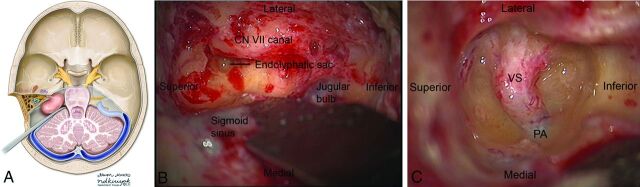 Post-contrast MRI showing a vestibular schwannoma in the cerebellopontine angle with extension into the internal auditory canal