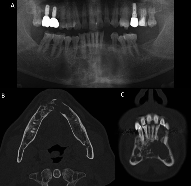 Panoramic radiograph and CT images showing multilocular ameloblastoma of the mandible with soap bubble appearance