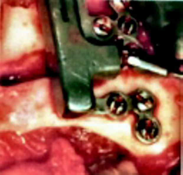 Intraoral photograph showing a vertical distraction osteogenesis device positioned on the mandibular ramus