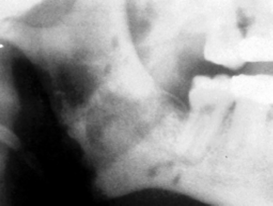 Lateral cephalograph showing evidence of new bone formation in the mandibular ramus after distraction osteogenesis