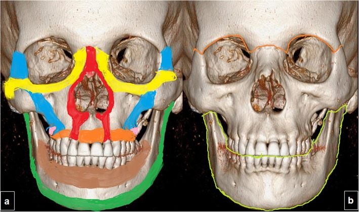 3D CT reconstruction of the facial skeleton showing the system of vertical and horizontal buttresses with color overlays