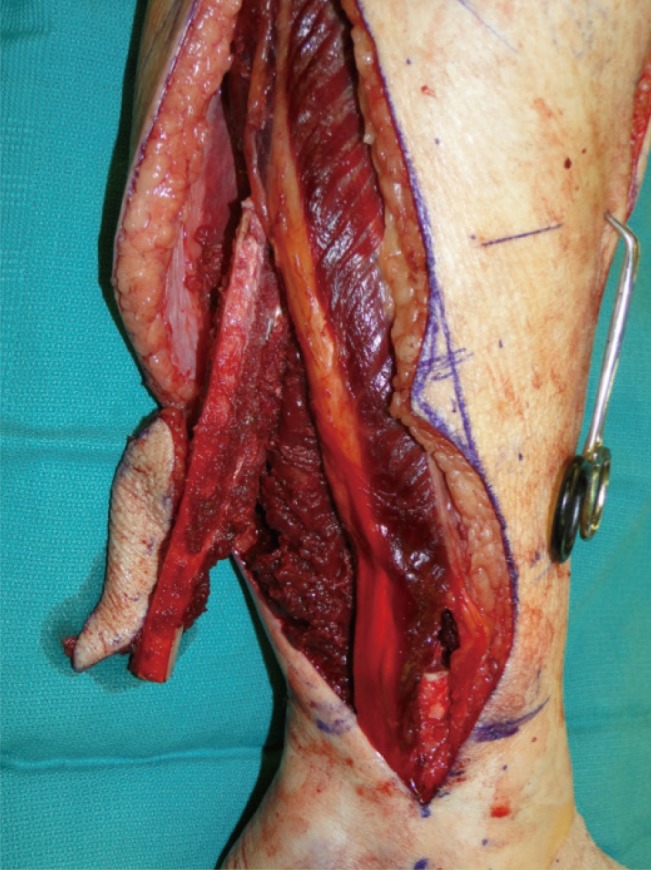 Osteoseptocutaneous fibula free flap harvested and displayed showing the vascular pedicle, bone segment, and skin paddle