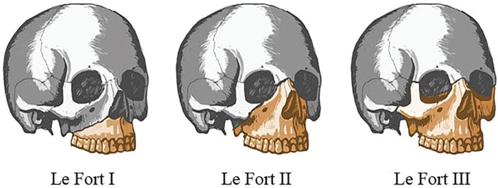 Illustration showing the three Le Fort fracture classification patterns (Type I horizontal, Type II pyramidal, Type III craniofacial dysjunction) on anterior view of skull
