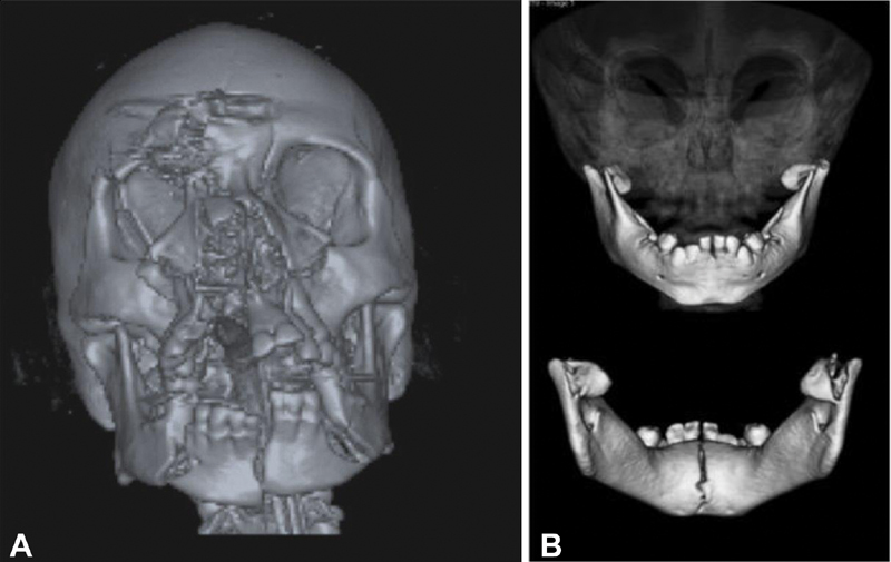 Three-dimensional CT reconstruction of mandibular fracture showing displaced fragments and fracture lines