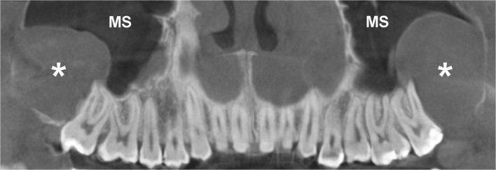 Panoramic radiograph showing multiple bilateral odontogenic keratocysts in a patient with Gorlin syndrome (basal cell nevus syndrome)