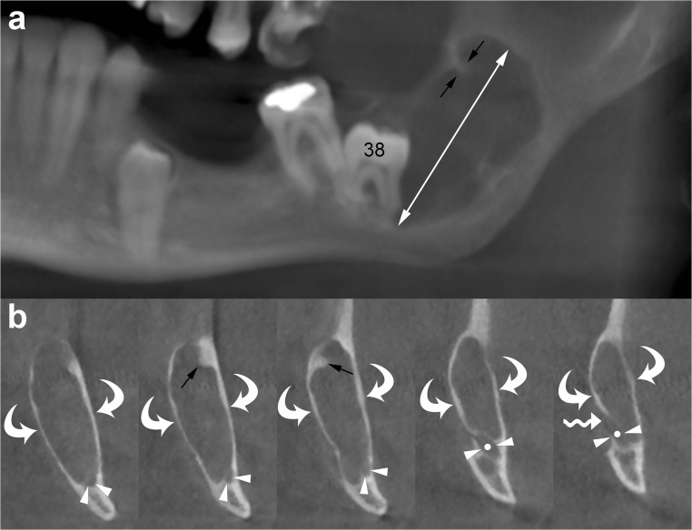 CBCT showing odontogenic keratocyst with characteristic mesiodistal growth pattern and minimal buccolingual expansion in the mandible