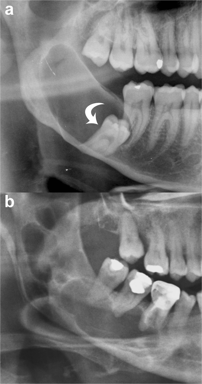 Panoramic radiograph and CT showing mandibular odontogenic keratocysts with unilocular and multilocular radiolucencies