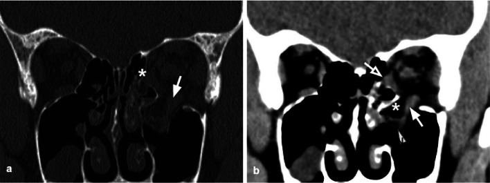 CT showing orbital floor trapdoor fracture with soft tissue entrapment and restricted eye movement