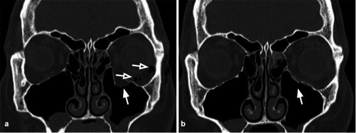 Coronal CT scan demonstrating orbital floor blowout fracture with herniation of orbital contents into the maxillary sinus