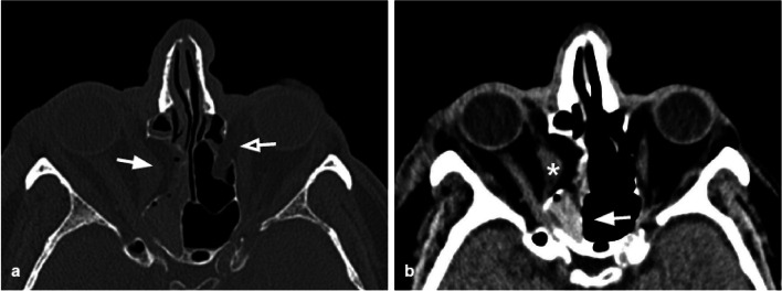 CT scan showing titanium mesh orbital floor implant reconstruction after blowout fracture repair