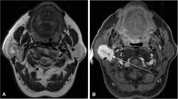 T2-weighted and contrast-enhanced MR images showing adenoid cystic carcinoma of the salivary gland with perineural invasion pattern