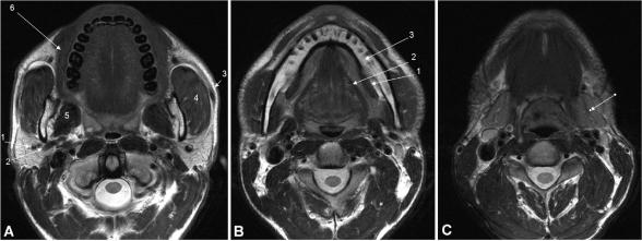 Axial T2-weighted MRI showing normal parotid, sublingual, and submandibular gland anatomy with labeled structures