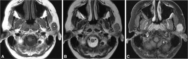 MRI of mucoepidermoid carcinoma in the parotid gland showing the tumor and relationship to the facial nerve