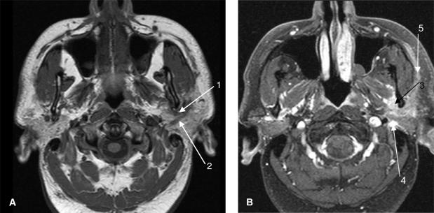 T1-weighted and contrast-enhanced MR images showing perineural spread of tumor along facial nerve branches