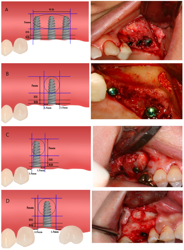 Classification diagram for lateral window sinus floor elevation showing implant position relative to residual bone height and sinus anatomy