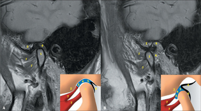 Sagittal PD-weighted MRI images and schematic drawings demonstrating TMJ anatomy in closed-mouth and open-mouth positions