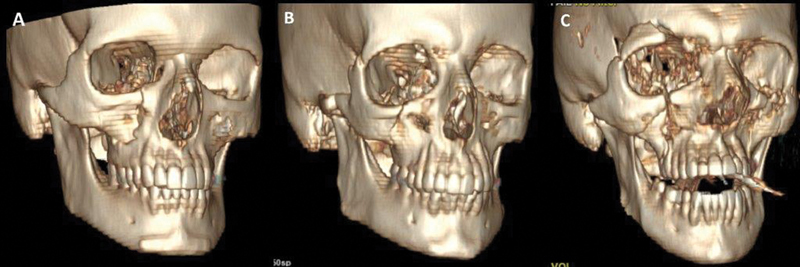 CT images demonstrating low, middle, and high energy zygomatic complex fracture patterns with varying degrees of comminution