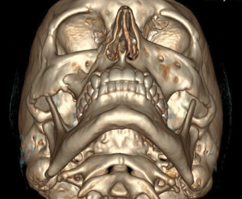 3D CT showing ZMC fracture with impaction and rotation pattern demonstrating medial rotation of the zygoma