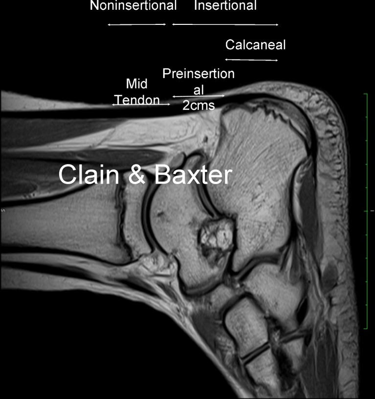 Anatomy of the Achilles tendon showing the gastrocnemius and soleus muscles converging into the tendon with the watershed zone of hypovascularity marked