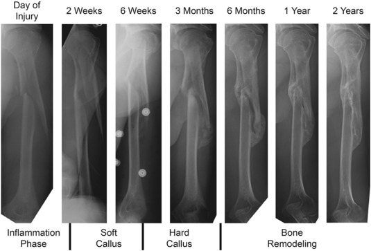 Diagram showing the four stages of fracture repair: hematoma formation, soft callus, hard callus, and bone remodeling