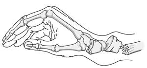 Diagram showing named distal radius fracture patterns including Colles, Smith, Barton, and chauffeur fractures