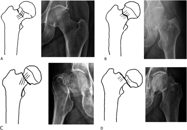 Garden classification of femoral neck fractures showing Types I through IV with progressive displacement patterns