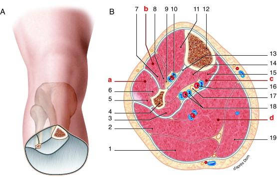 Clinical presentation of posterior hip dislocation showing characteristic limb position of flexion, adduction, and internal rotation