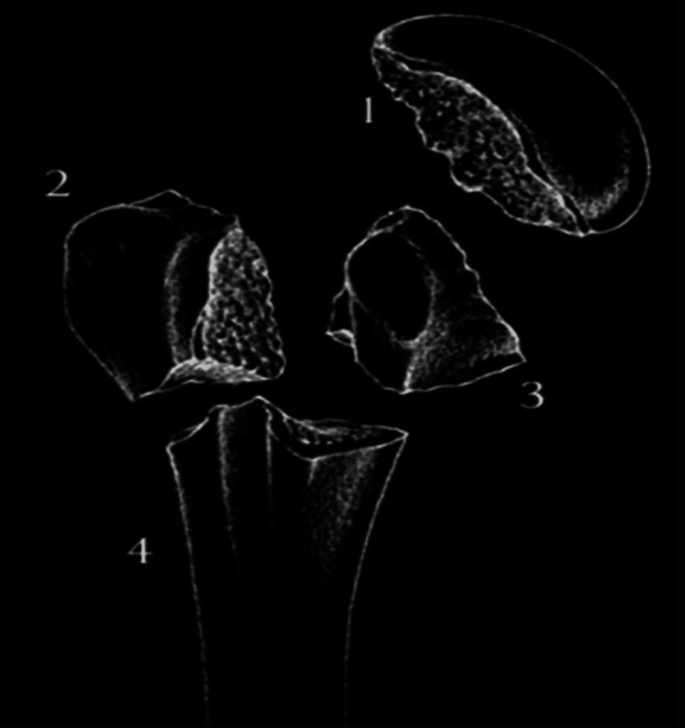 Diagram showing the four anatomical segments of the proximal humerus used in Neer classification: greater tuberosity, lesser tuberosity, articular surface, and shaft