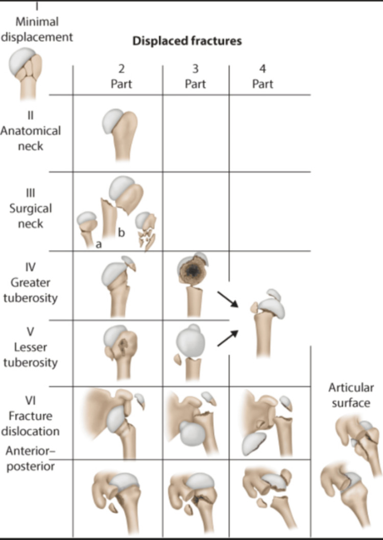 Neer classification system for proximal humerus fractures showing one-part through four-part fracture patterns