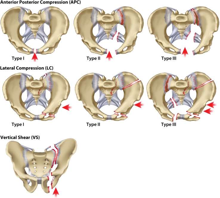 Young-Burgess classification of pelvic ring injuries showing lateral compression, anteroposterior compression, and vertical shear patterns