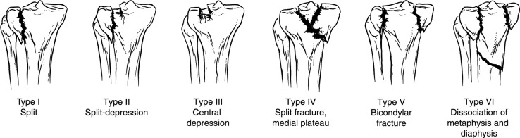 Schatzker classification of tibial plateau fractures showing Types I through VI with progressive complexity
