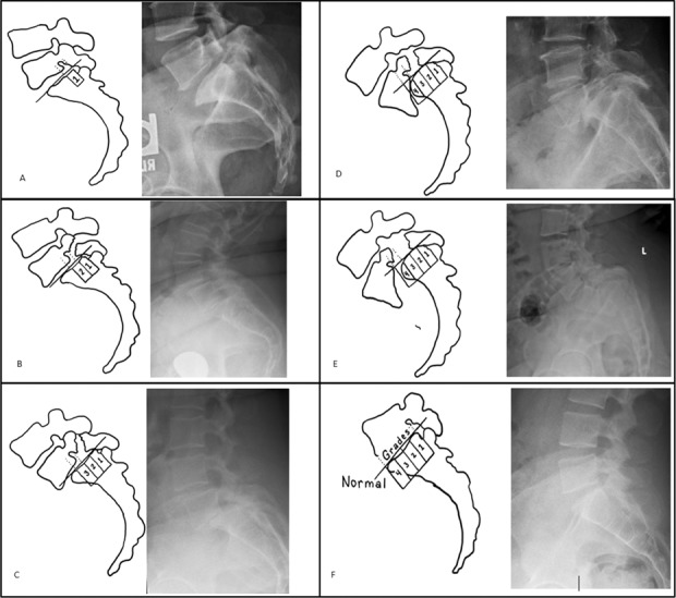 Meyerding grading system for spondylolisthesis showing grades I through V based on percentage of vertebral body slip