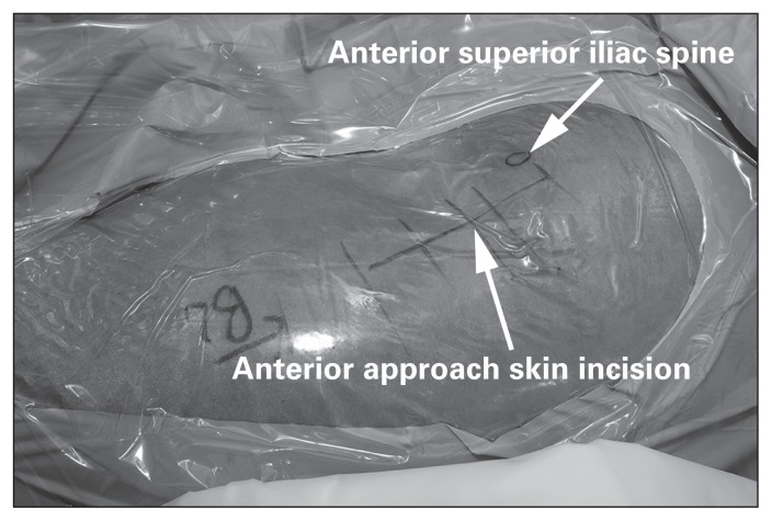 Direct anterior approach to the hip showing the internervous interval between tensor fasciae latae and sartorius