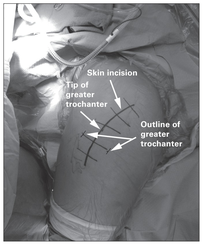 Posterior approach to the hip showing gluteus maximus splitting, short external rotator detachment, and relationship to the sciatic nerve