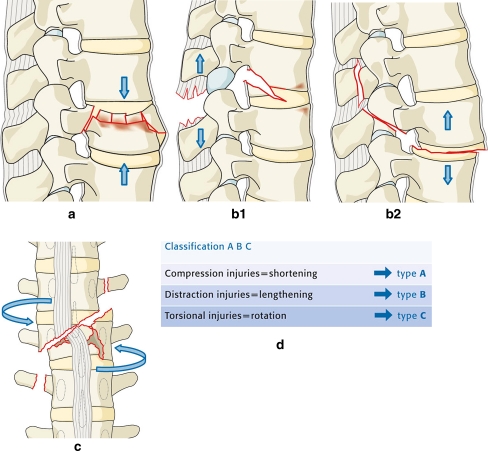 Diagram showing thoracolumbar fracture types including compression, burst, flexion-distraction (Chance), and fracture-dislocation patterns