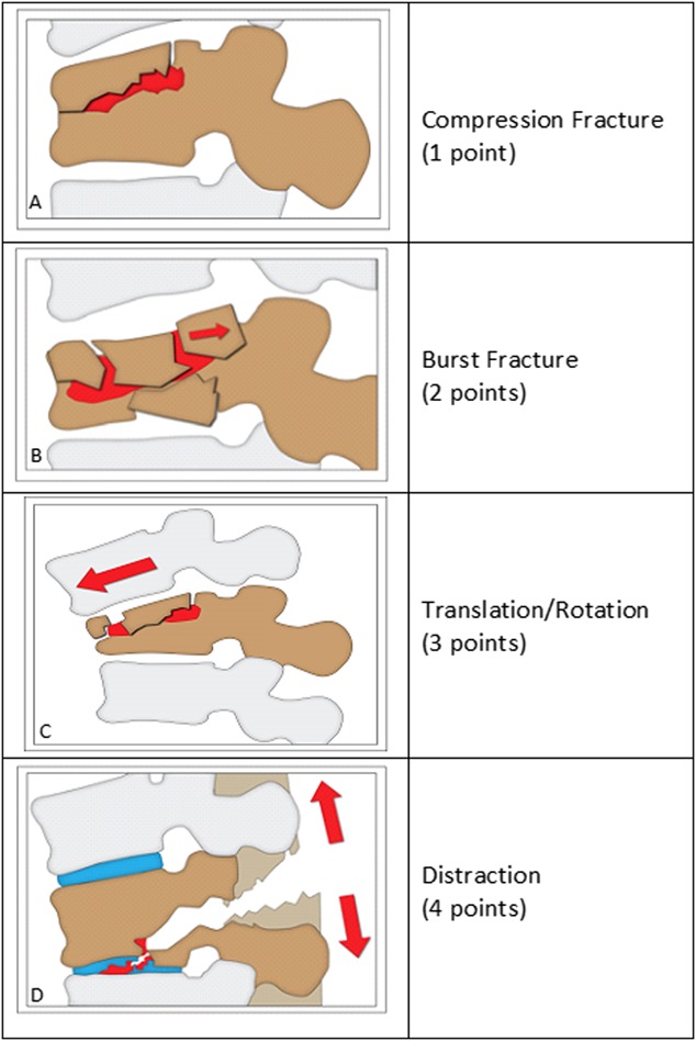 TLICS scoring system showing point values for morphology, posterior ligamentous complex integrity, and neurological status