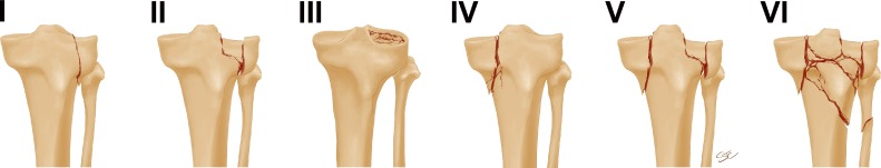 Weber classification of ankle fractures showing Type A (below syndesmosis), Type B (at syndesmosis), and Type C (above syndesmosis)