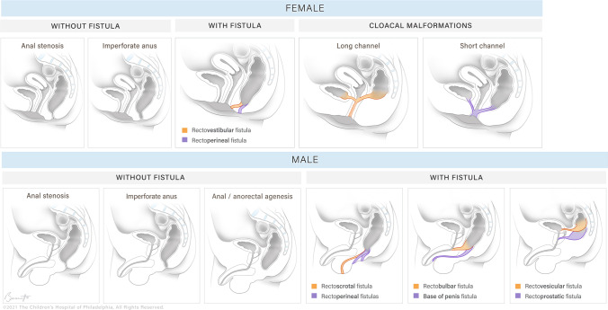 Sagittal illustrations of common anorectal malformations in males and females showing spectrum from perineal fistula to cloacal malformation