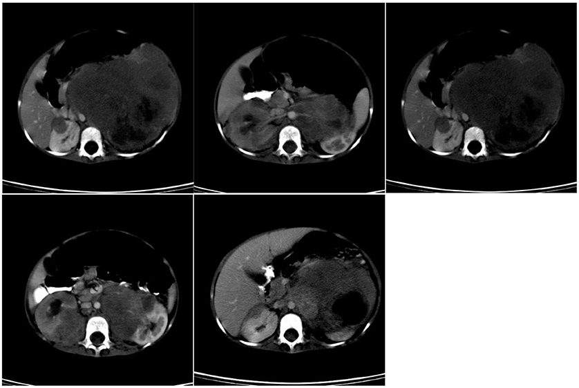Diagram illustrating the patent processus vaginalis and its relationship to indirect inguinal hernia in pediatric patients