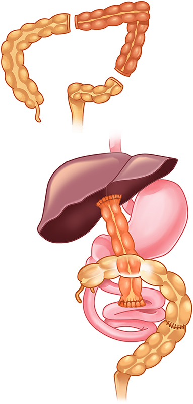 Surgical illustration of the Kasai hepatoportoenterostomy procedure showing Roux-en-Y limb anastomosed to the porta hepatis