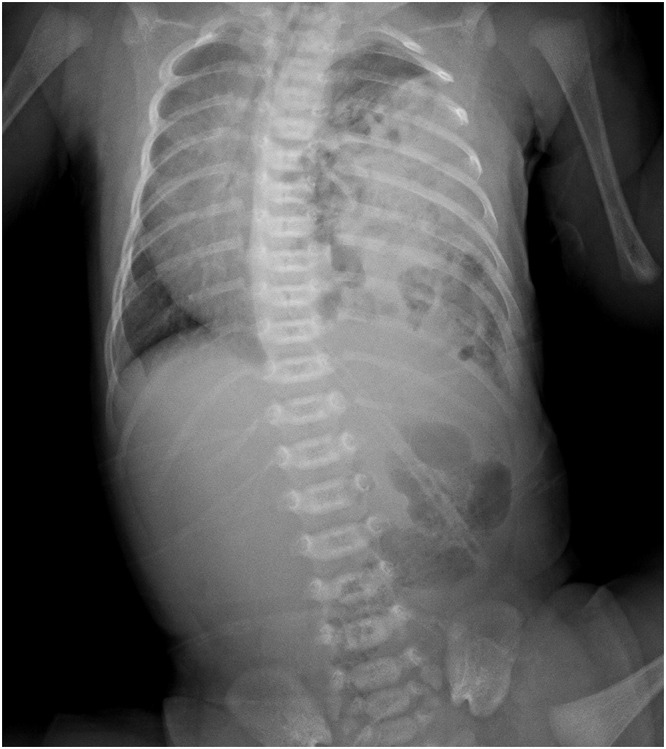 Chest X-ray of a neonate with left-sided congenital diaphragmatic hernia showing bowel loops in the thorax and mediastinal shift