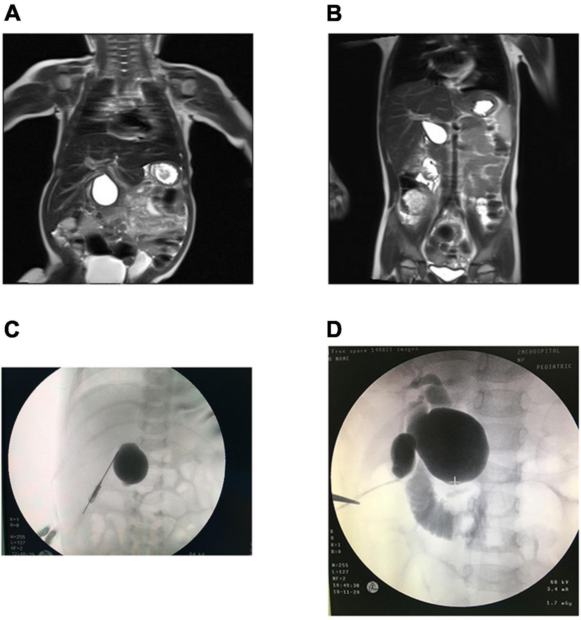 Comparative imaging of cystic biliary atresia and choledochal cyst types showing ultrasonographic and surgical findings