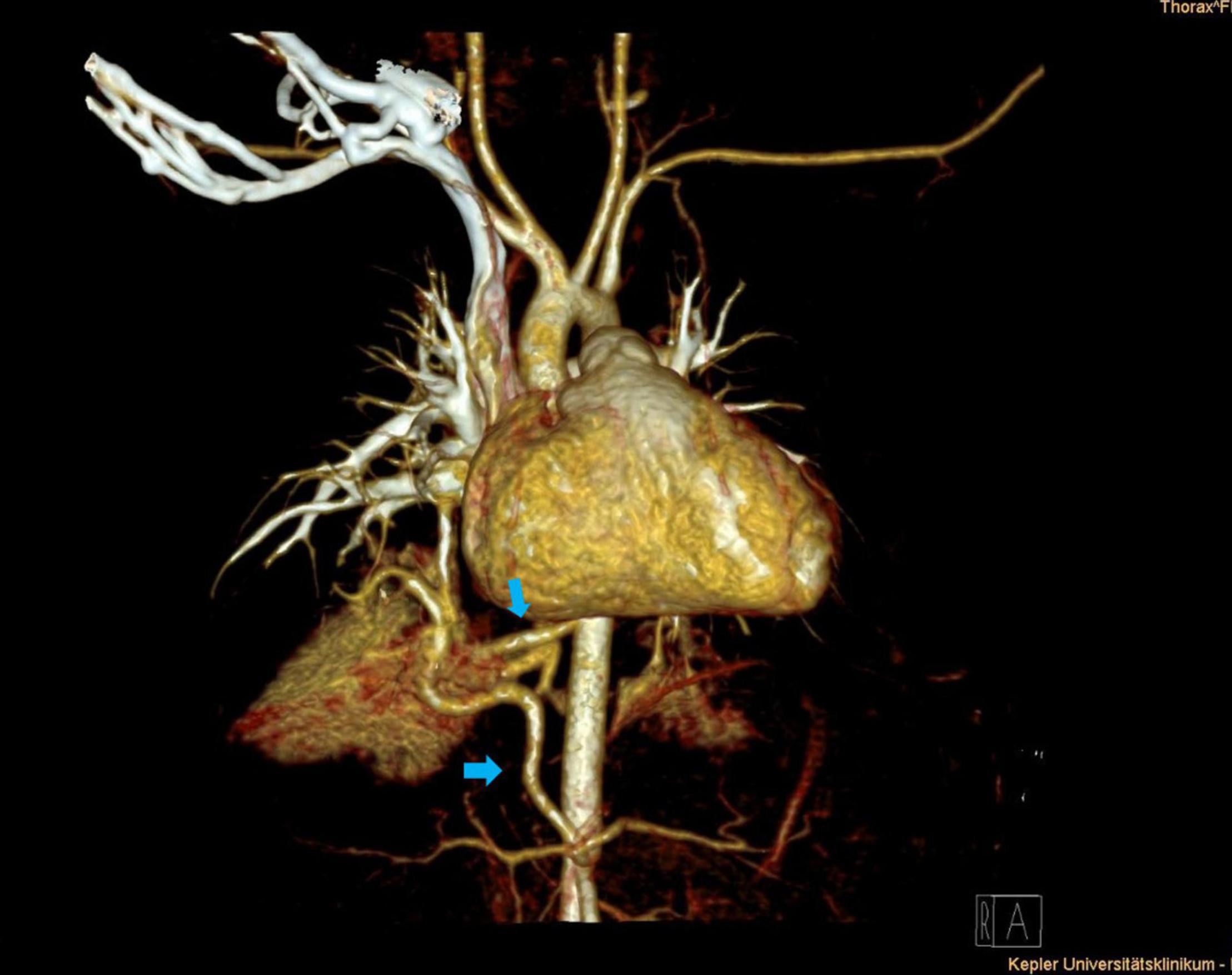 CT imaging of congenital pulmonary airway malformation showing cystic lung lesion with vascular anatomy